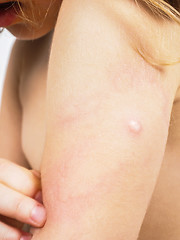 Image showing Child with hive, rash, or some skin abnormality towards white