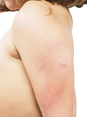 Image showing Child with hive, rash, or some skin abnormality towards white