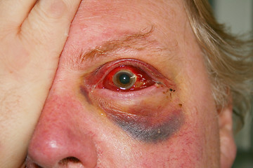 Image showing damaged eye