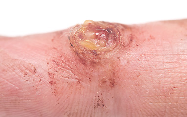 Image showing wart