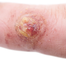 Image showing wart