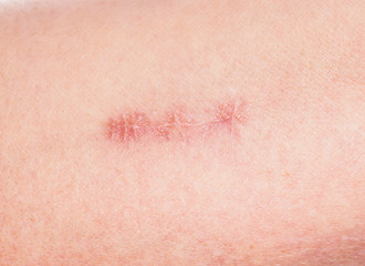 Image showing Closeup of redness around healing stitches on skin