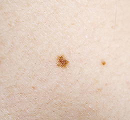 Image showing mole