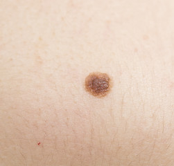 Image showing mole