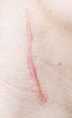 Image showing scar