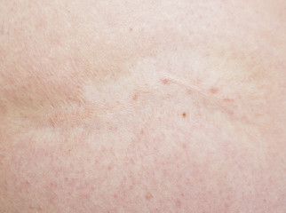 Image showing scar