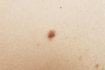 Image showing mole