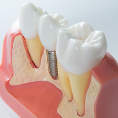 Image showing Dental implant