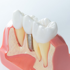 Image showing Dental implant