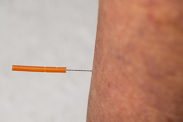Image showing acupuncture treatment on leg