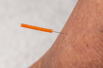 Image showing acupuncture treatment on leg