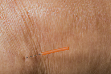 Image showing acupuncture treatment on leg