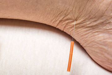 Image showing acupuncture treatment on leg