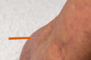 Image showing acupuncture treatment on leg