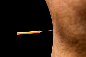 Image showing acupuncture treatment on leg