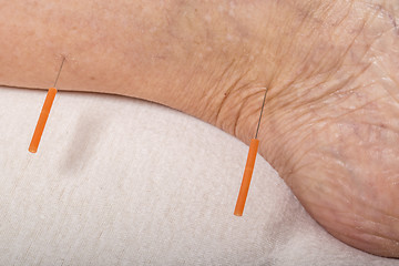 Image showing acupuncture treatment on leg