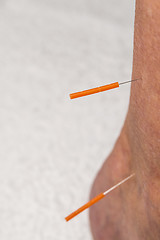 Image showing acupuncture treatment on leg