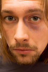 Image showing Young man with black eye