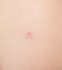 Image showing insect bite