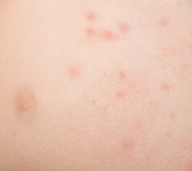 Image showing rash