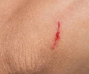 Image showing wound
