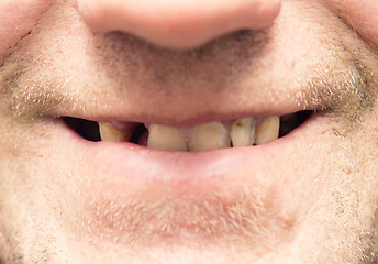 Image showing bad teeth