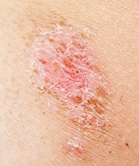 Image showing wound