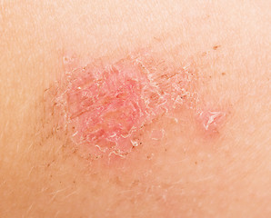 Image showing wound