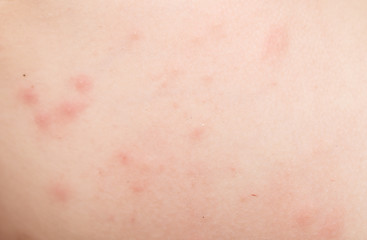 Image showing rash