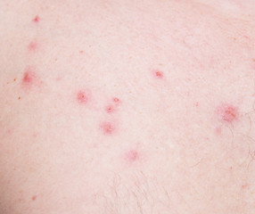 Image showing pimples