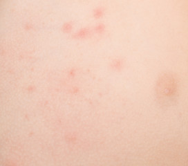 Image showing rash