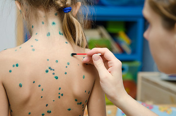 Image showing Lubrication zelenkoj chickenpox sores on back of a little girl