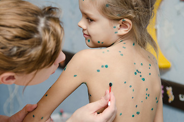 Image showing Little girl with chickenpox sores smeared zelenkoj