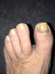 Image showing Toe nails with mucosis