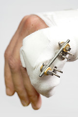 Image showing External rig to mend a broken hand