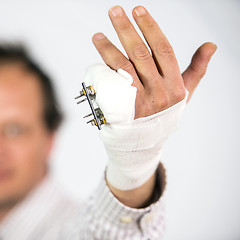 Image showing Fractured pinky finger