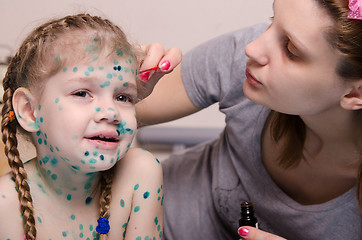 Image showing Mom misses zelenkoj rash on face of child with chickenpox