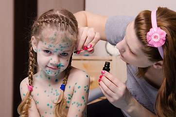 Image showing Mom cauterize zelenkoj chickenpox rash in a child