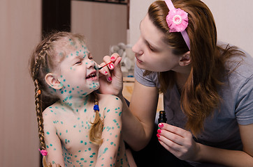 Image showing Mom smears child with chickenpox sores zelenkoj