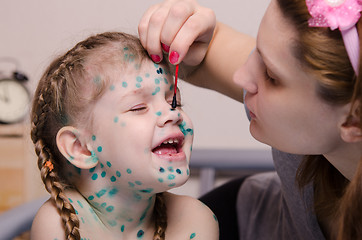 Image showing Mom misses zelenkoj sores in a child with chickenpox