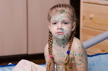 Image showing The little girl suffering from chicken pox all smeared zelenkoj