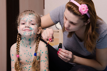 Image showing Mom misses the little girl with chickenpox sores zelenkoj