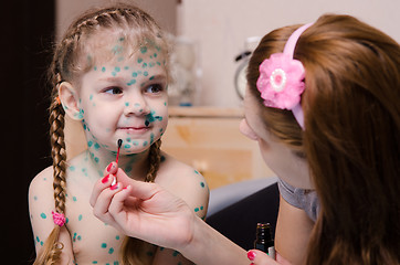 Image showing Mom cauterize zelenkoj rash in a child with chickenpox