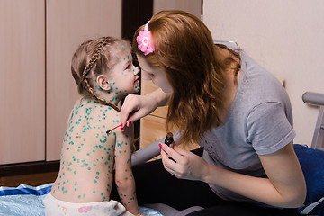 Image showing Girl suffering from chickenpox sores mom misses zelenkoj