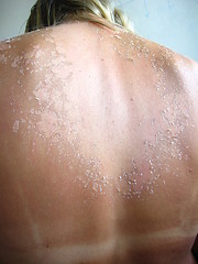 Image showing Burn from the sun on the body