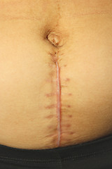 Image showing seams after the operation of Caesarian section