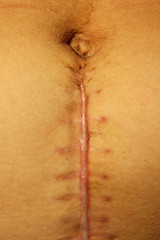 Image showing seams after the operation of Caesarian section