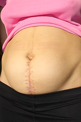 Image showing seams after the operation of Caesarian section