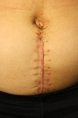 Image showing seams after the operation of Caesarian section