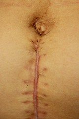 Image showing seams after the operation of Caesarian section